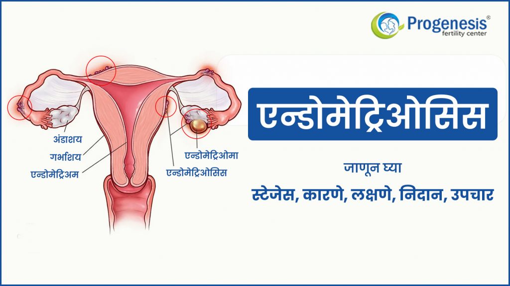 एंडोमेट्रिओसिस | endometriosis in marathi