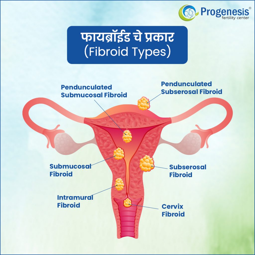 फायब्रॉईड चे प्रकार | Types of Fibroid 