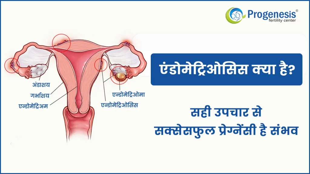 Endometriosis in Hindi