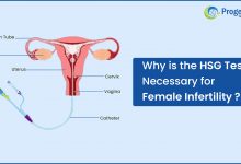 HSG Test for Female Infertility